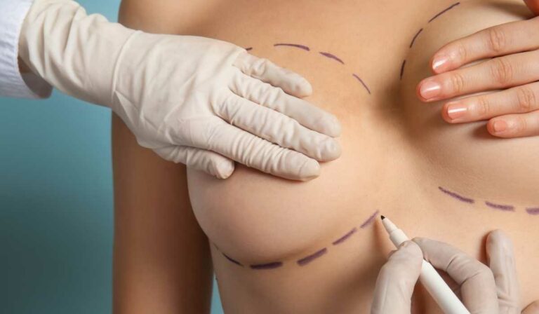 عملية رفع الثدي